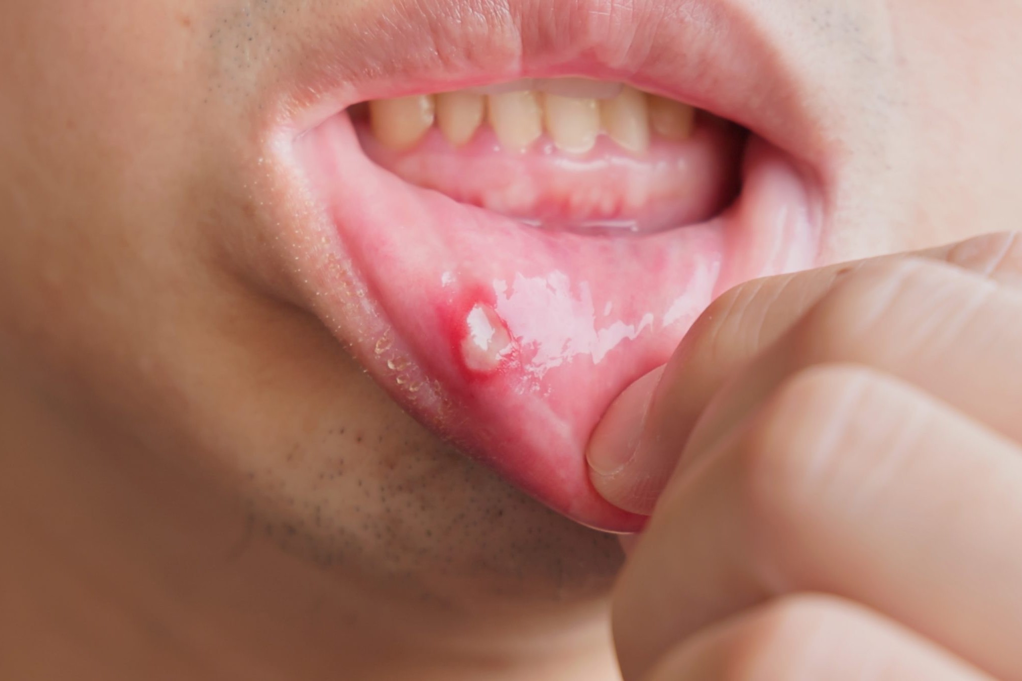 32 Hechos Sobre Estomatitis