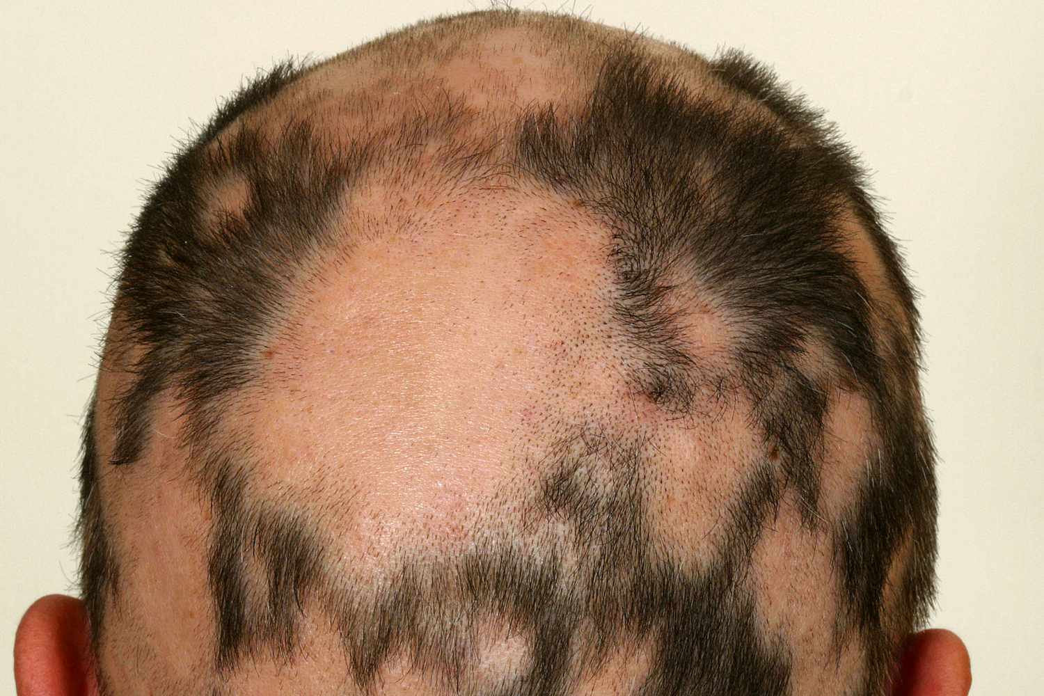 36 Hechos Sobre Alopecia