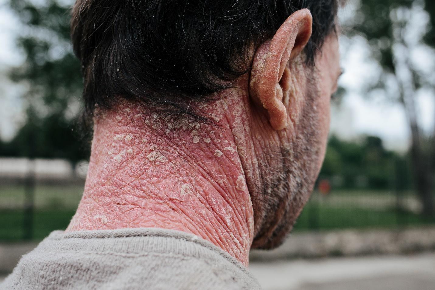 40 Hechos Sobre Psoriasis